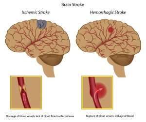 2 types of stroke